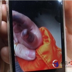 5角硬币莫名爆炸灼伤2岁女童